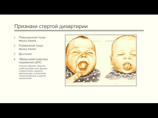 Признаки стертой дизартирии Повышенный тонус мышц языка Сниженный тонус мышц языка Дистония