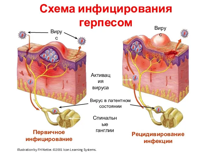 Схема инфицирования герпесом Вирус Спинальные ганглии Вирус в латентном состоянии Активация вируса