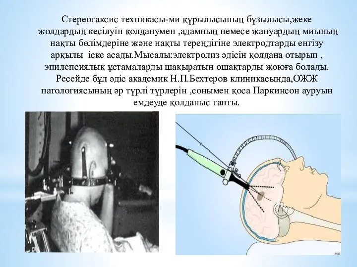 Стереотаксис техникасы-ми құрылысының бұзылысы,жеке жолдардың кесілуін қолданумен ,адамның немесе жануардың миының нақты