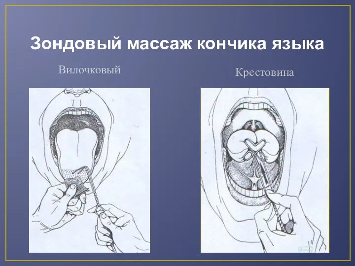 Зондовый массаж кончика языка Вилочковый Крестовина