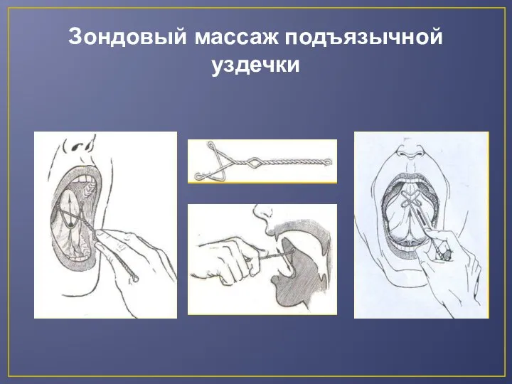 Зондовый массаж подъязычной уздечки