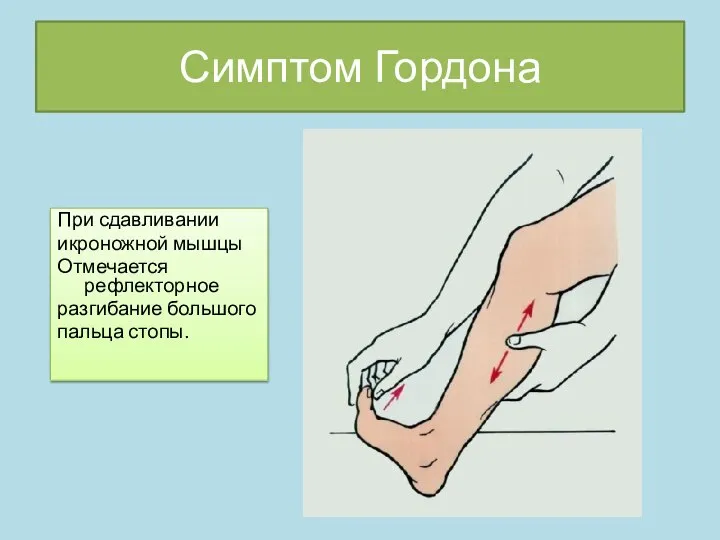 Симптом Гордона При сдавливании икроножной мышцы Отмечается рефлекторное разгибание большого пальца стопы.