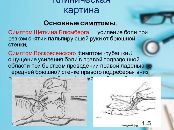 Клиническая картина Основные симптомы: Симптом Щеткина-Блюмберга — усиление боли при резком снятии