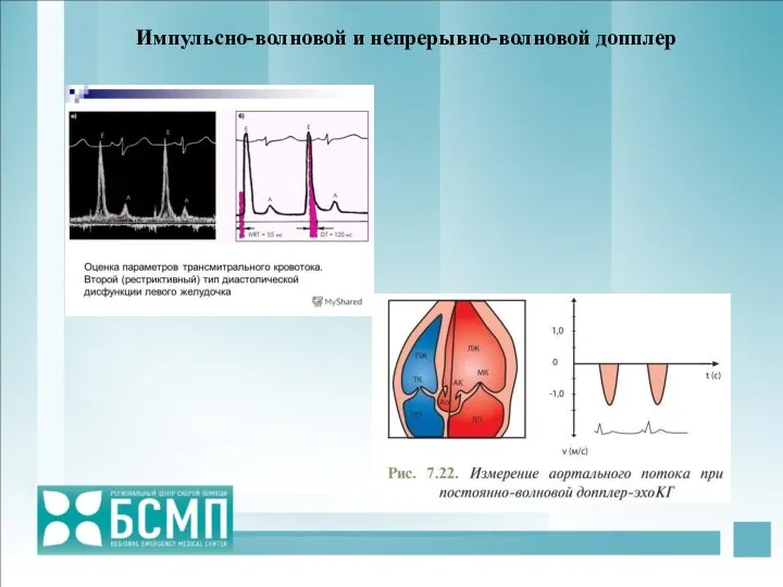 Импульсно-волновой и непрерывно-волновой допплер