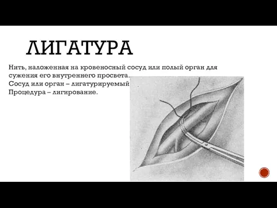 ЛИГАТУРА Нить, наложенная на кровеносный сосуд или полый орган для сужения его