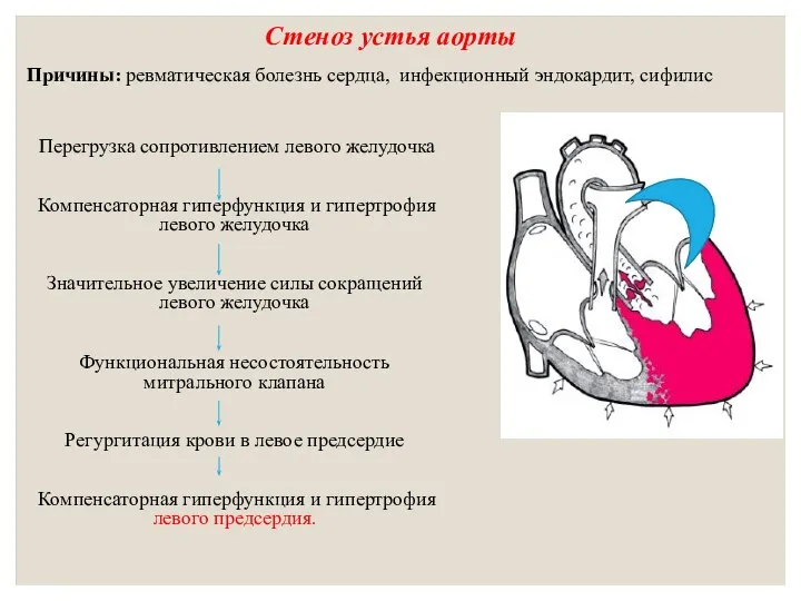 Стеноз устья аорты Перегрузка сопротивлением левого желудочка Компенсаторная гиперфункция и гипертрофия левого