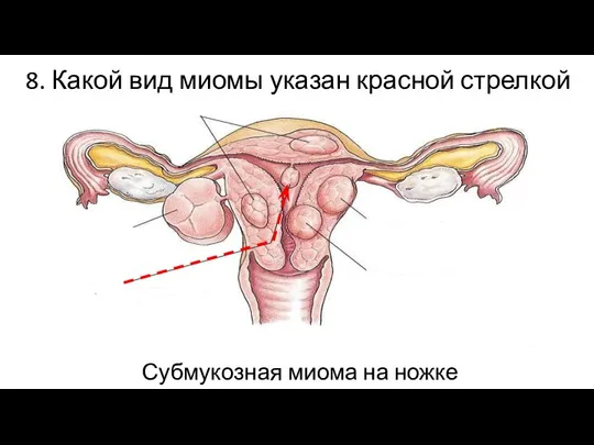 8. Какой вид миомы указан красной стрелкой ? Субмукозная миома на ножке