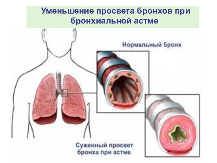 Уменьшение просвета бронхов при бронхиальной астме