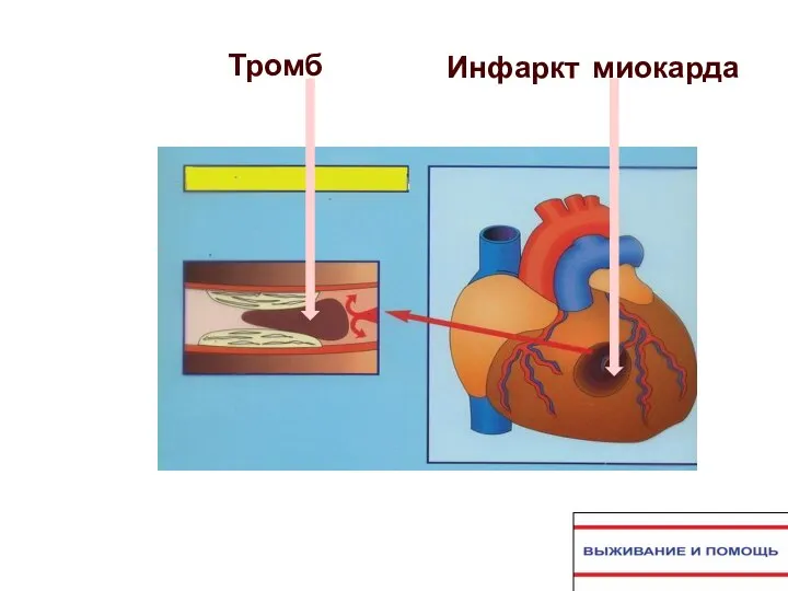 Инфаркт миокарда Тромб