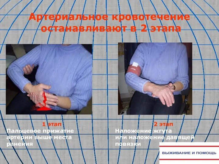 Артериальное кровотечение останавливают в 2 этапа 1 этап Пальцевое прижатие артерии выше