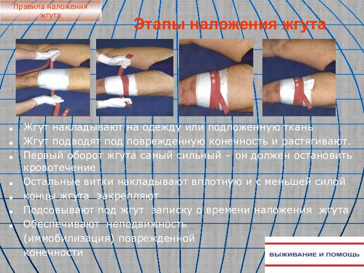 Этапы наложения жгута Жгут накладывают на одежду или подложенную ткань Жгут подводят