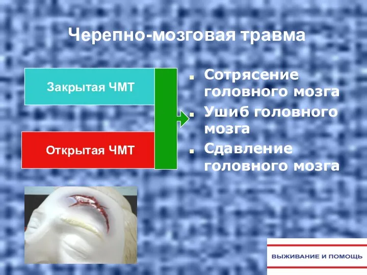 Черепно-мозговая травма Сотрясение головного мозга Ушиб головного мозга Сдавление головного мозга Закрытая ЧМТ Открытая ЧМТ