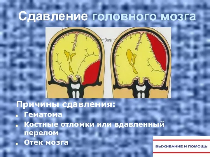 Сдавление головного мозга Причины сдавления: Гематома Костные отломки или вдавленный перелом Отек мозга