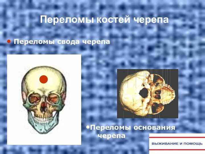 Переломы костей черепа Переломы свода черепа Переломы основания черепа