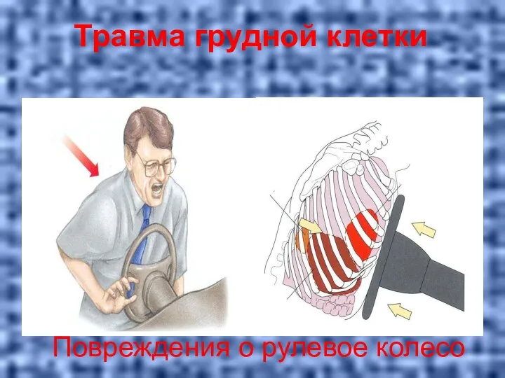 Повреждения о рулевое колесо Травма грудной клетки