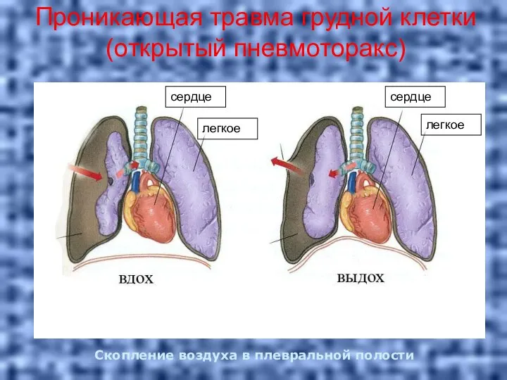 Проникающая травма грудной клетки (открытый пневмоторакс) сердце легкое легкое сердце Скопление воздуха в плевральной полости