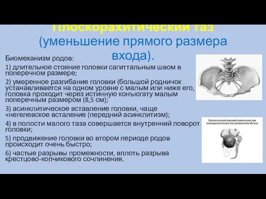 Плоскорахитический таз (уменьшение прямого размера входа). Биомеханизм родов: 1) длительное стояние головки