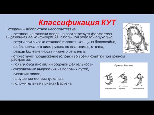 Классификация КУТ II степень – абсолютное несоответствие: - вставление головки плода не