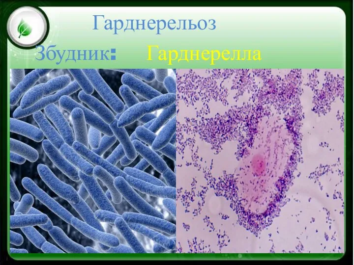 Гарднерельоз Збудник: Гарднерелла