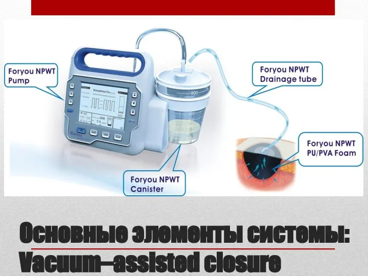 Основные элементы системы: Vacuum–assisted closure