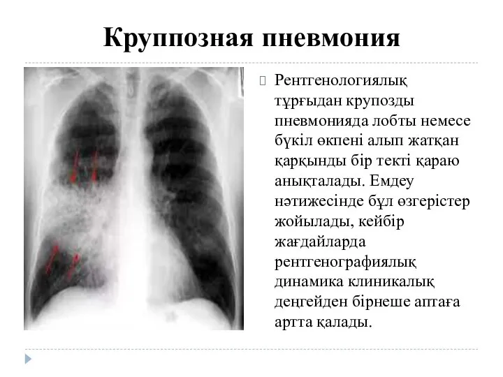 Круппозная пневмония Рентгенологиялық тұрғыдан крупозды пневмонияда лобты немесе бүкіл өкпені алып жатқан