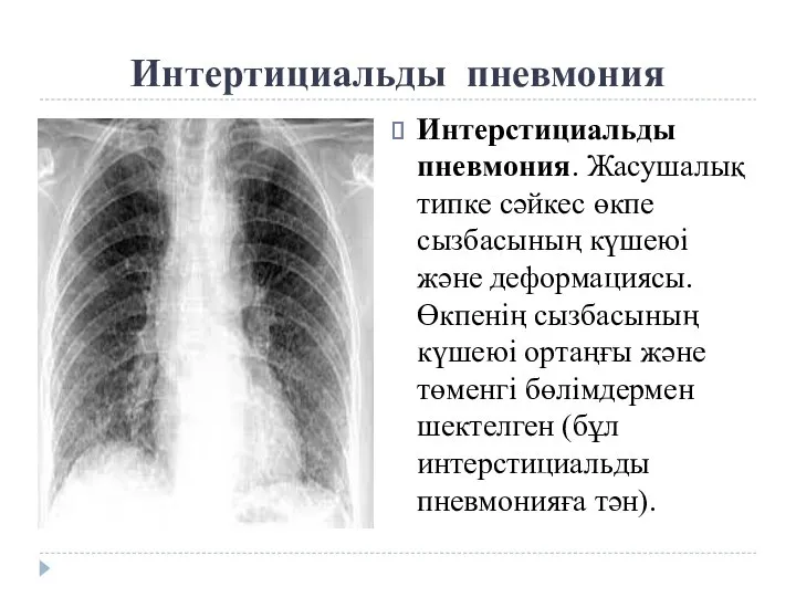 Интертициальды пневмония Интерстициальды пневмония. Жасушалық типке сәйкес өкпе сызбасының күшеюі және деформациясы.