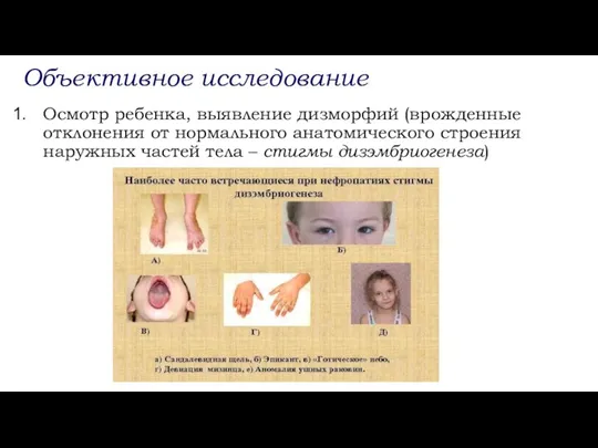 Объективное исследование Осмотр ребенка, выявление дизморфий (врожденные отклонения от нормального анатомического строения