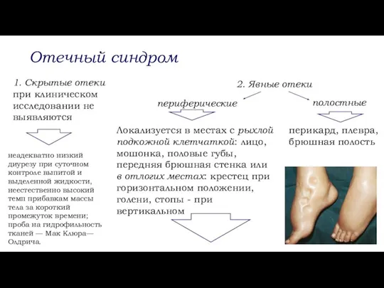 Отечный синдром 1. Скрытые отеки при клиническом исследовании не выявляются 2. Явные