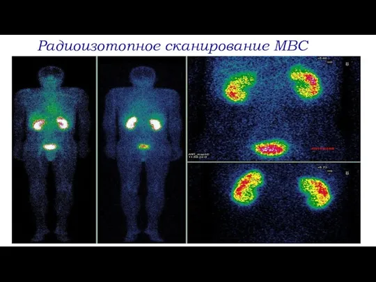 Радиоизотопное сканирование МВС