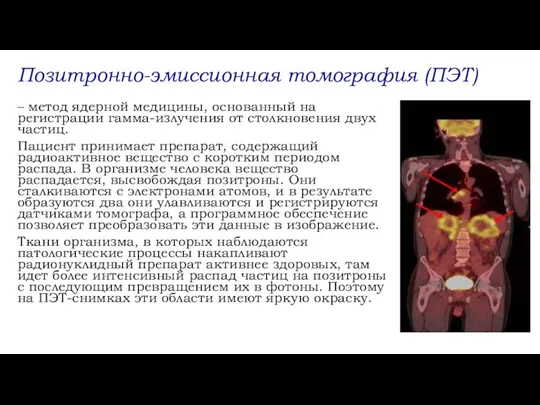 Позитронно-эмиссионная томография (ПЭТ) – метод ядерной медицины, основанный на регистрации гамма-излучения от