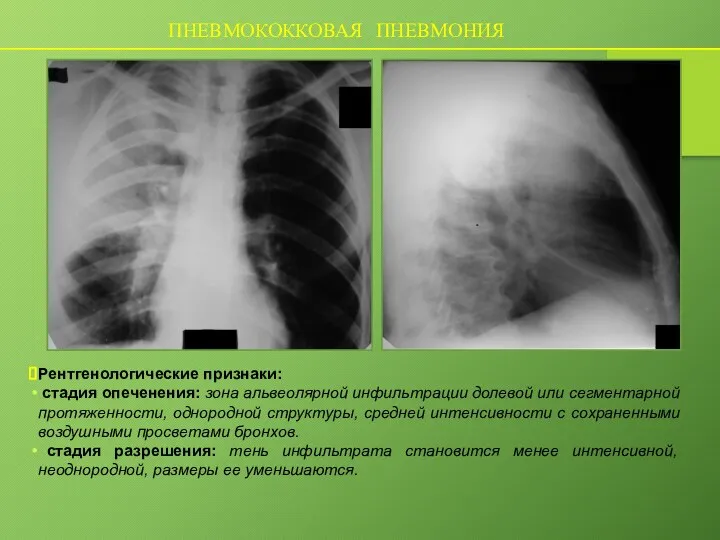 ПНЕВМОКОККОВАЯ ПНЕВМОНИЯ Рентгенологические признаки: стадия опеченения: зона альвеолярной инфильтрации долевой или сегментарной