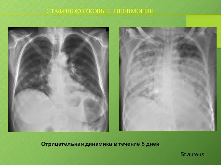 St.aureus Отрицательная динамика в течение 5 дней СТАФИЛОКОККОВЫЕ ПНЕВМОНИИ