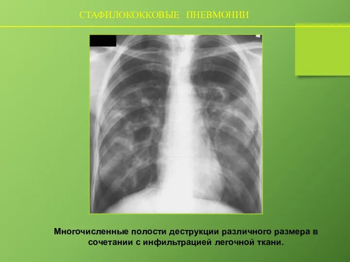 СТАФИЛОКОККОВЫЕ ПНЕВМОНИИ Многочисленные полости деструкции различного размера в сочетании с инфильтрацией легочной ткани.