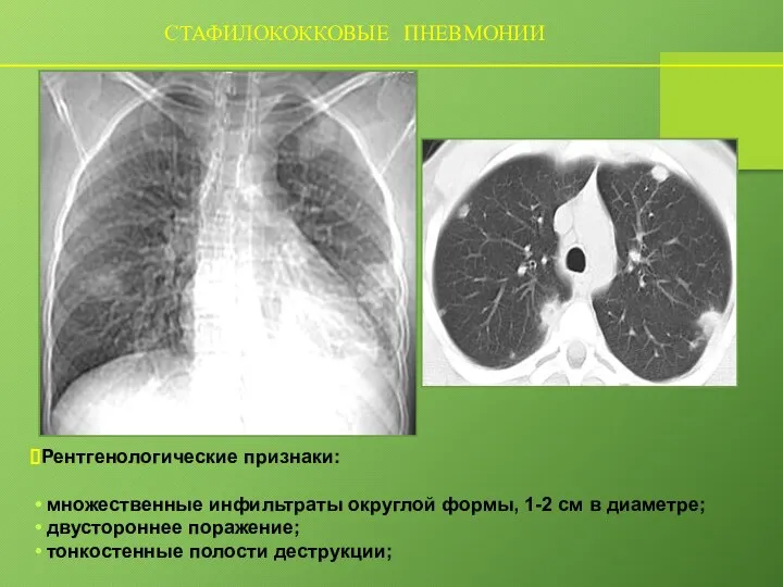 СТАФИЛОКОККОВЫЕ ПНЕВМОНИИ Рентгенологические признаки: множественные инфильтраты округлой формы, 1-2 см в диаметре;