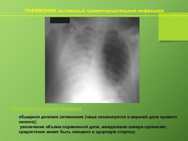 ПНЕВМОНИИ, вызванные граммотрицательной инфекцией обширное долевое затемнение (чаще локализуется в верхней доле