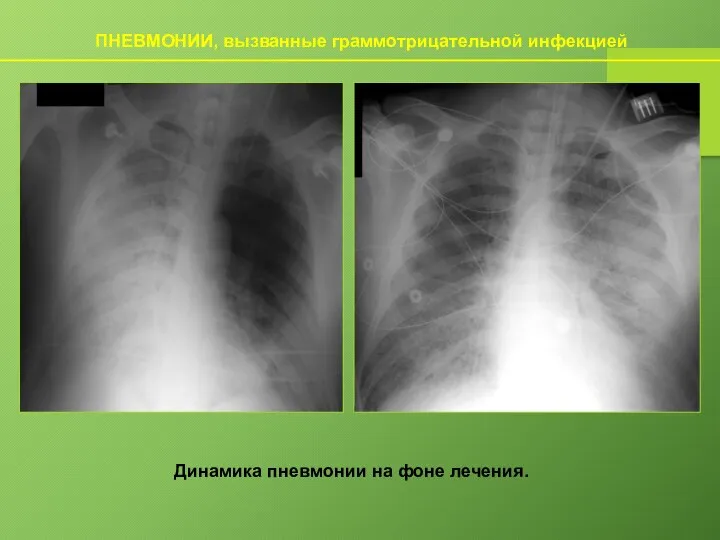 ПНЕВМОНИИ, вызванные граммотрицательной инфекцией Динамика пневмонии на фоне лечения.