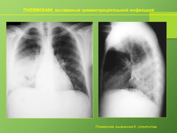 ПНЕВМОНИИ, вызванные граммотрицательной инфекцией Пневмония, вызванная K. pneumoniae