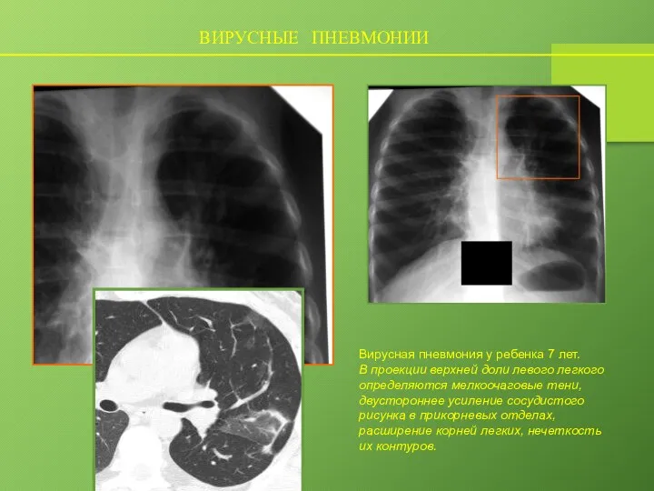 ВИРУСНЫЕ ПНЕВМОНИИ Вирусная пневмония у ребенка 7 лет. В проекции верхней доли