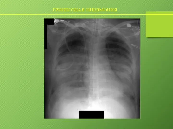 ГРИППОЗНАЯ ПНЕВМОНИЯ