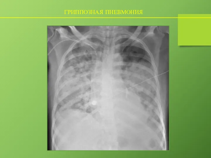 ГРИППОЗНАЯ ПНЕВМОНИЯ
