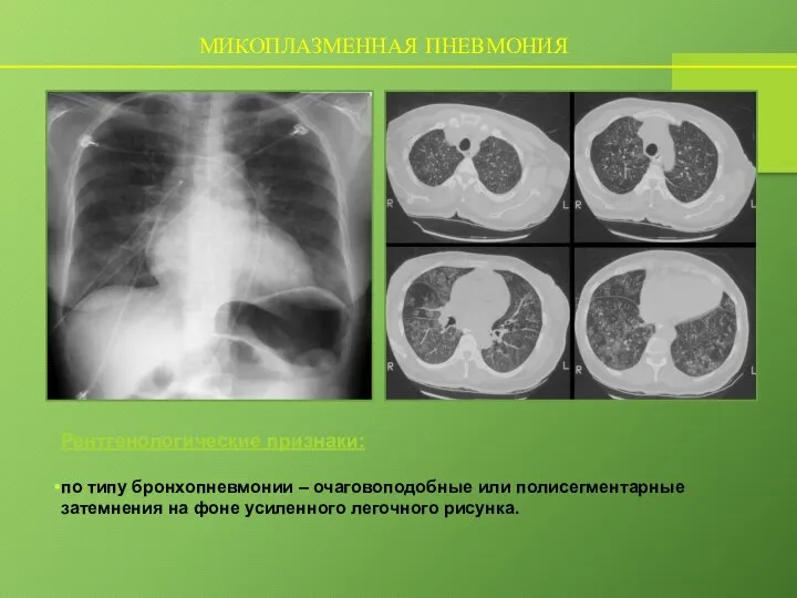 МИКОПЛАЗМЕННАЯ ПНЕВМОНИЯ Рентгенологические признаки: по типу бронхопневмонии – очаговоподобные или полисегментарные затемнения