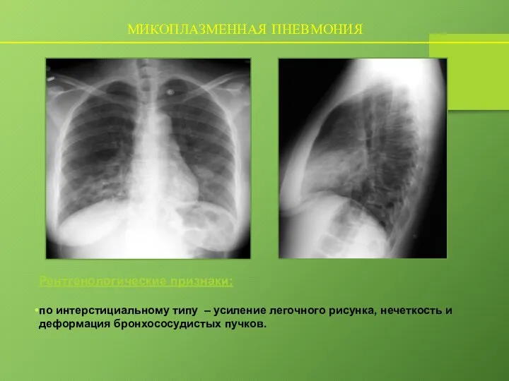 МИКОПЛАЗМЕННАЯ ПНЕВМОНИЯ Рентгенологические признаки: по интерстициальному типу – усиление легочного рисунка, нечеткость и деформация бронхососудистых пучков.