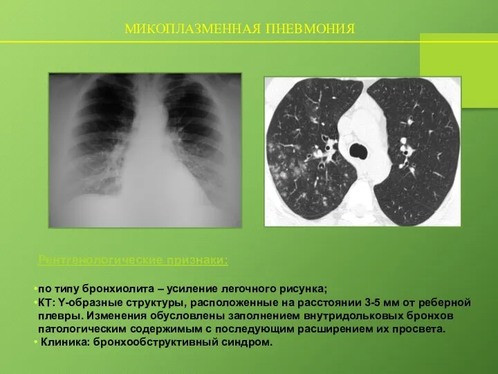 МИКОПЛАЗМЕННАЯ ПНЕВМОНИЯ Рентгенологические признаки: по типу бронхиолита – усиление легочного рисунка; КТ: