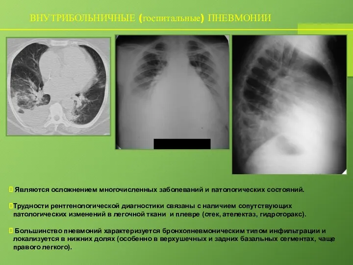 ВНУТРИБОЛЬНИЧНЫЕ (госпитальные) ПНЕВМОНИИ Являются осложнением многочисленных заболеваний и патологических состояний. Трудности рентгенологической