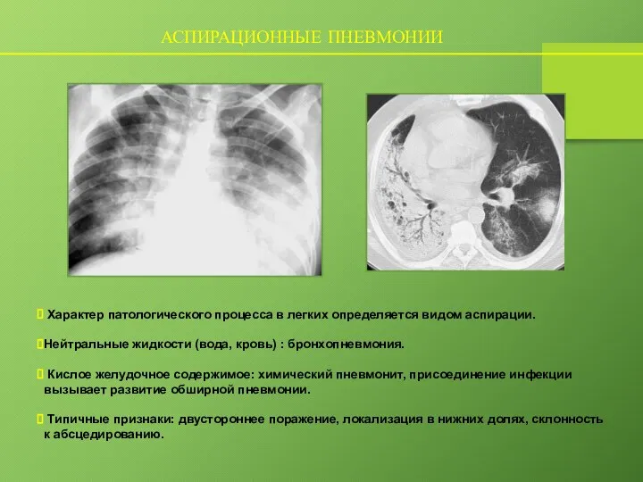 АСПИРАЦИОННЫЕ ПНЕВМОНИИ Характер патологического процесса в легких определяется видом аспирации. Нейтральные жидкости