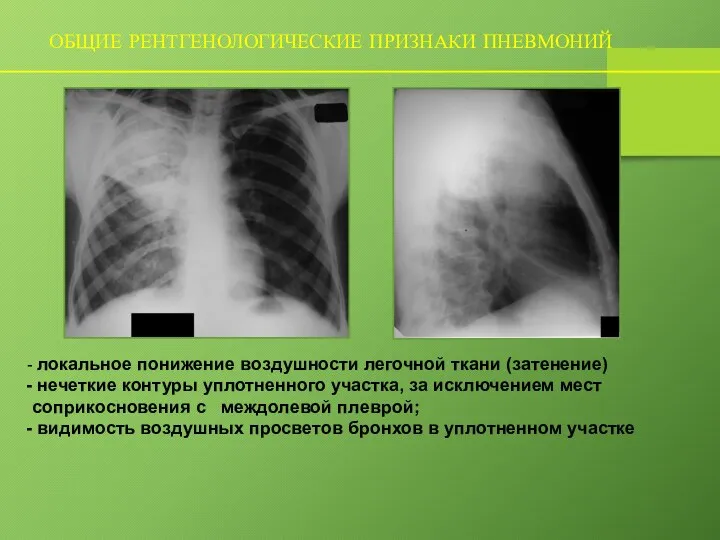 ОБЩИЕ РЕНТГЕНОЛОГИЧЕСКИЕ ПРИЗНАКИ ПНЕВМОНИЙ локальное понижение воздушности легочной ткани (затенение) нечеткие контуры