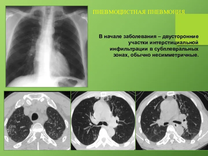 ПНЕВМОЦИСТНАЯ ПНЕВМОНИЯ В начале заболевания – двусторонние участки интерстициальной инфильтрации в субплевральных зонах, обычно несимметричные.