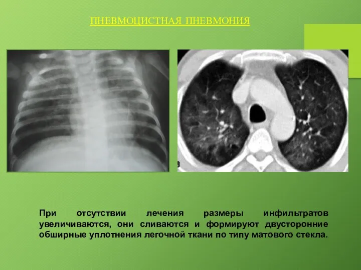 ПНЕВМОЦИСТНАЯ ПНЕВМОНИЯ При отсутствии лечения размеры инфильтратов увеличиваются, они сливаются и формируют