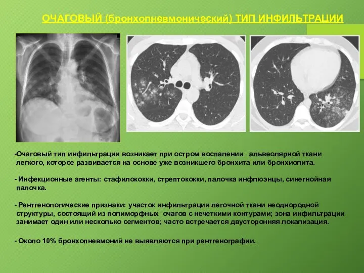 ОЧАГОВЫЙ (бронхопневмонический) ТИП ИНФИЛЬТРАЦИИ Очаговый тип инфильтрации возникает при остром воспалении альвеолярной
