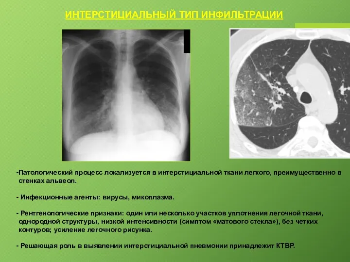 ИНТЕРСТИЦИАЛЬНЫЙ ТИП ИНФИЛЬТРАЦИИ Патологический процесс локализуется в интерстициальной ткани легкого, преимущественно в